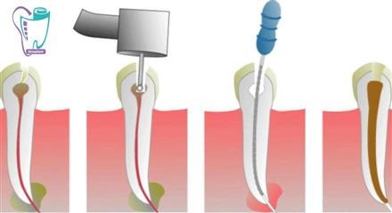 Dental sensitivity