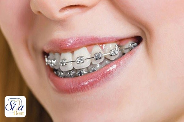 نصب ارتودنسی چقدر طول میکشد؟