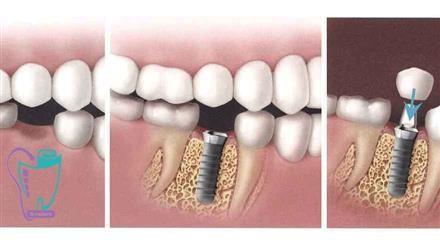 Implant definition