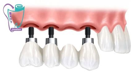 Implant definition