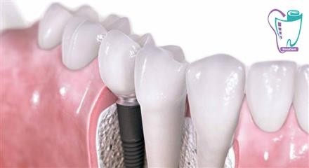 Implant definition