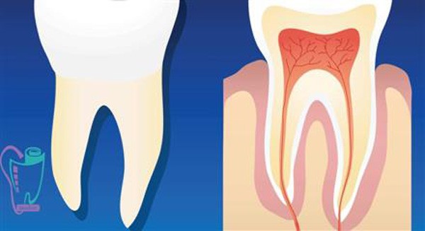 Root canal therapy