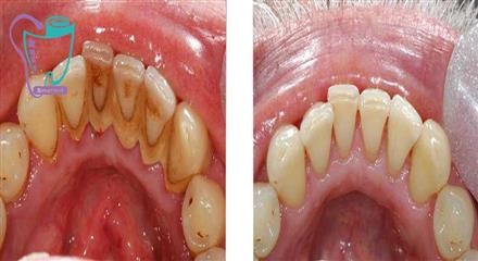 Scaling and restoration of the tooth