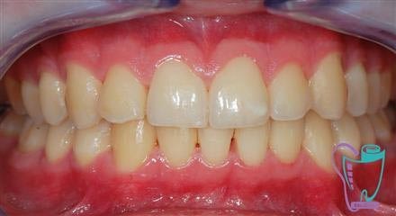 Scaling and restoration of the tooth