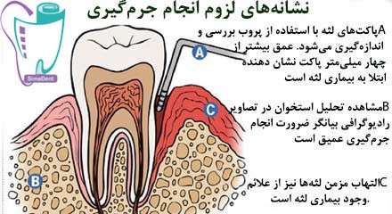 Scaling and restoration of the tooth