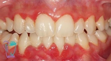 Scaling and restoration of the tooth