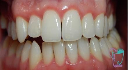 Scaling-and-restoration-of-the-tooth