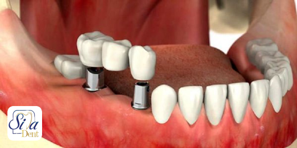علائم و درمان عفونت ایمپلنت دندان