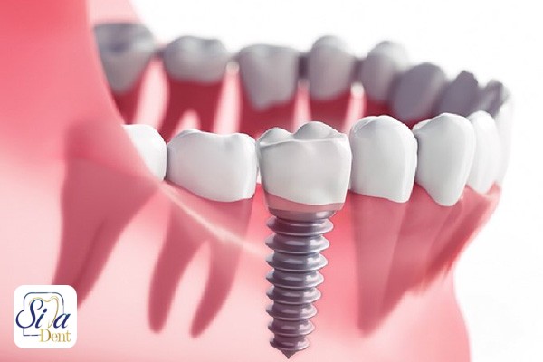 ایمپلنت دندان برای چه افرادی ممنوع است؟ 