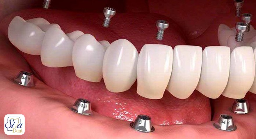 ایمپلنت دندان برای چه افرادی ممنوع است؟