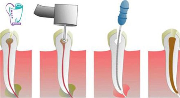 Root canal therapy