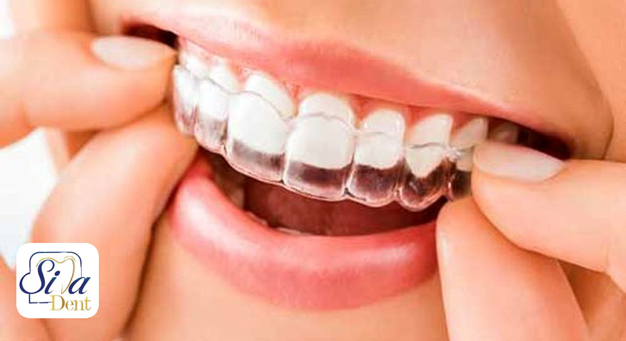 انواع روش های درمان ارتودنسی دندان