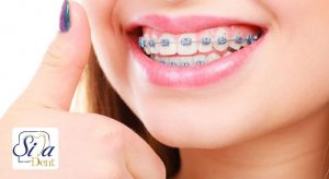 مزایای ارتودنسی دندان جلو