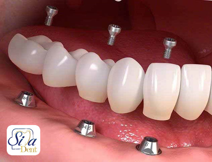شرایط ایمپلنت دندان