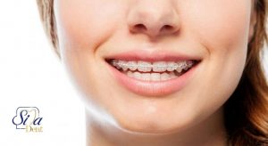 روش درمان و مراحل ارتودنسی ثابت دندان