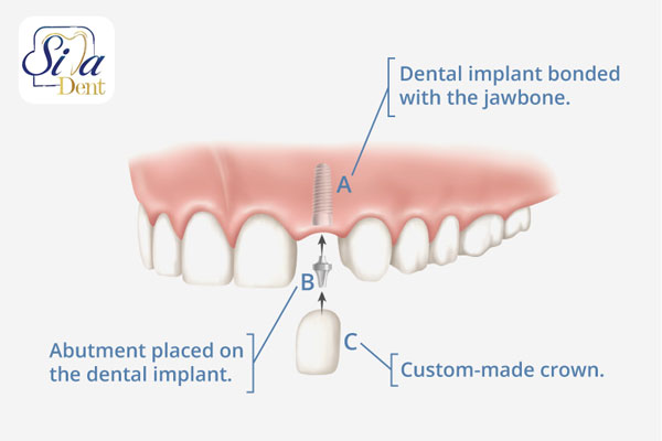 کاشت و ایمپلنت دندان طبیعی با پایه ایمپلنت