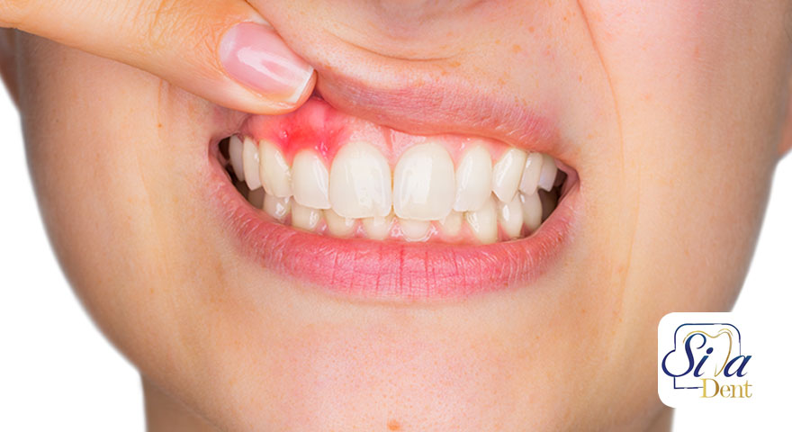 عفونت دندان 17