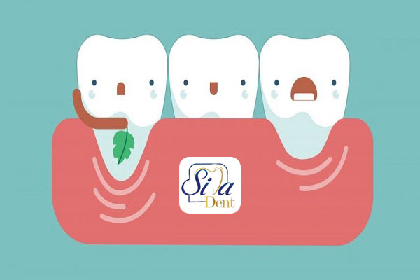 جلوگیری از تحلیل لثه بعد از کشیدن دندان