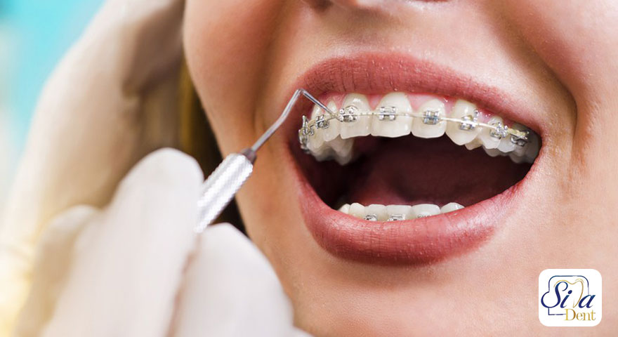 جرم گیری دندان بعد از ارتودنسی فک بالا