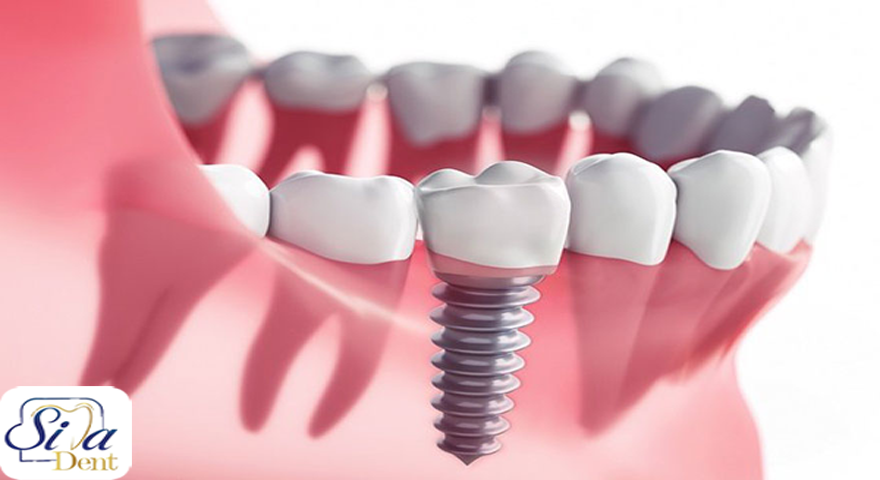 Evaluation of dental implant implantation and its weight