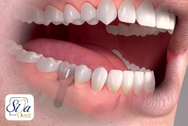 Duration of dental implant procedure