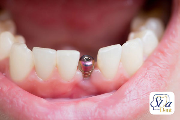 Duration of dental implant procedure