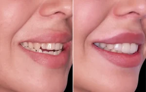 کامپوزیت دندان : عوارض کامپوزیت، عکس قبل و بعد + هزینه