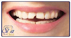 اصلاح دندان شکسته توسط بهترین دکتر کامپوزیت دندان