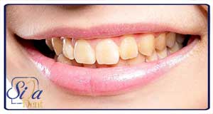 اصلاح بدرنگی دندان توسط متخصص کامپوزیت دندان