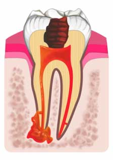 درمان پوسیدگی پالپ دندان با عصب کشی