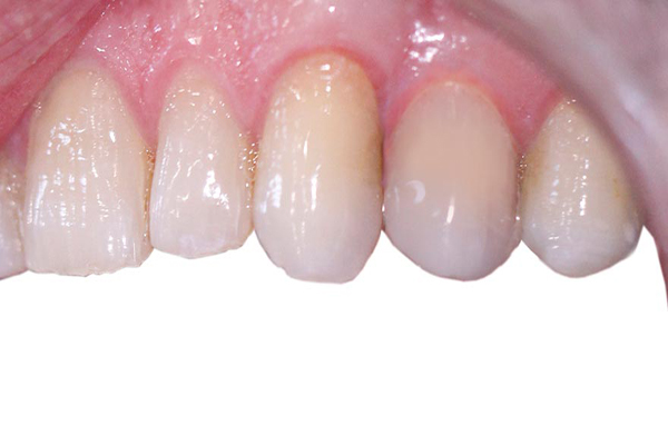 عکس ترمیم دندان : کامپوزیت دندان تخریب شده