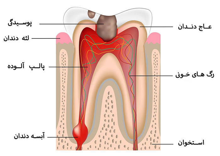 چگونه عفونت دندان را خارج کنیم؟