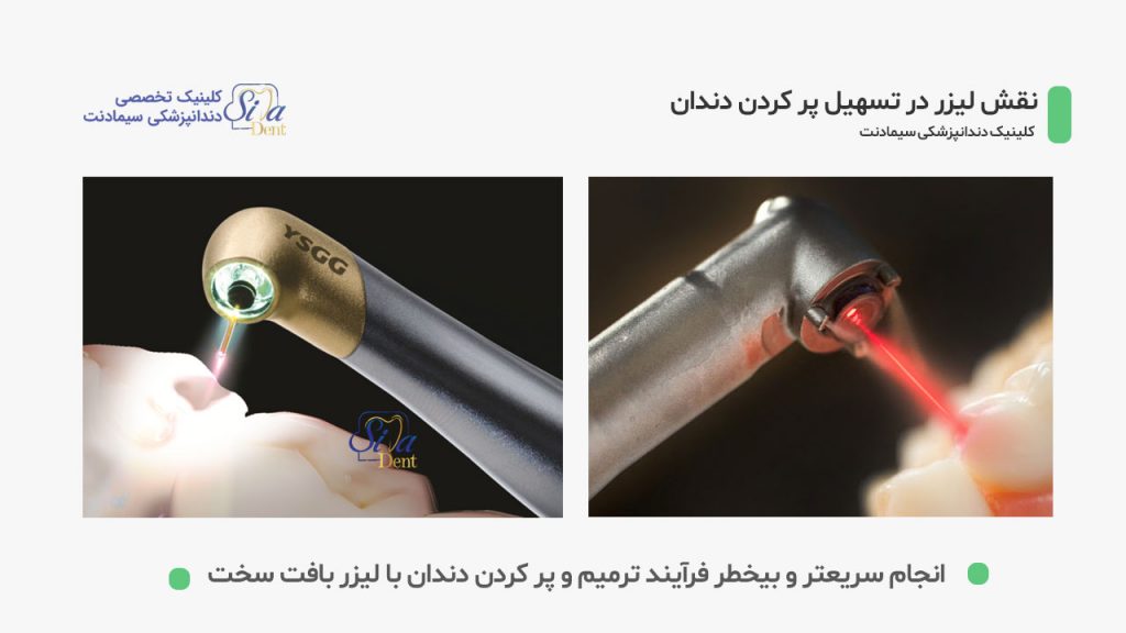کاربرد لیزر در تسهیل پر کردن دندان ها
