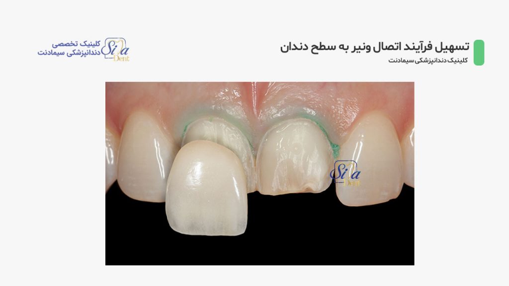 تصویر دندان های آماده شده جهت اتصال لمینت دندان