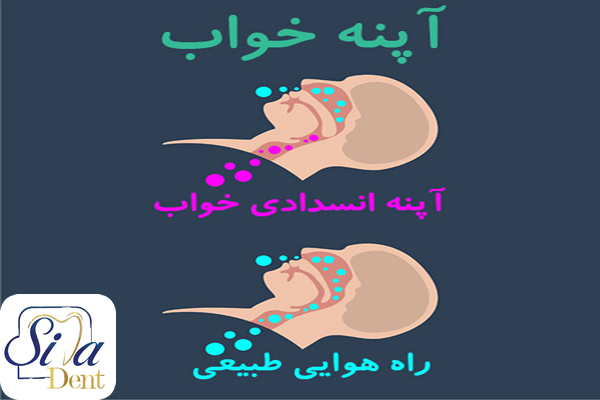 چرا باید آپنه (وقفه تنفسی) خواب درمان شود؟