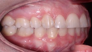 ارتودنسی نیش نهفته فک چپ