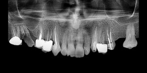 عکس XRay دندان