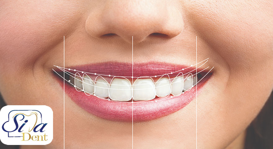 کراودینگ دندان چیست