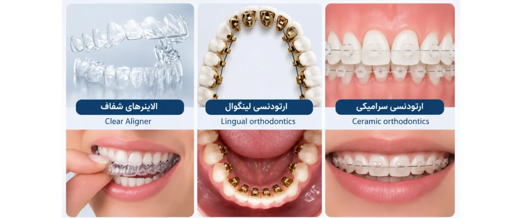 ارتودنسی نامرئی چیست؟ | راهنمای صفر تا صد ارتودنسی شفاف