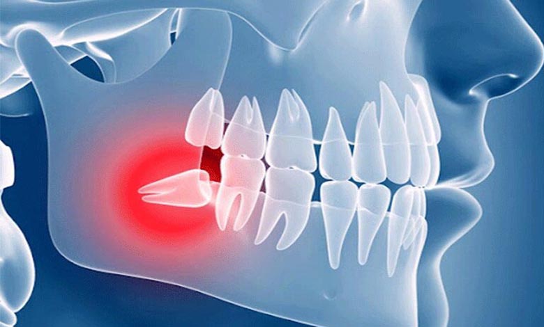 دندان عقل نیمه نهفته چیست و چه عوارضی دارد؟