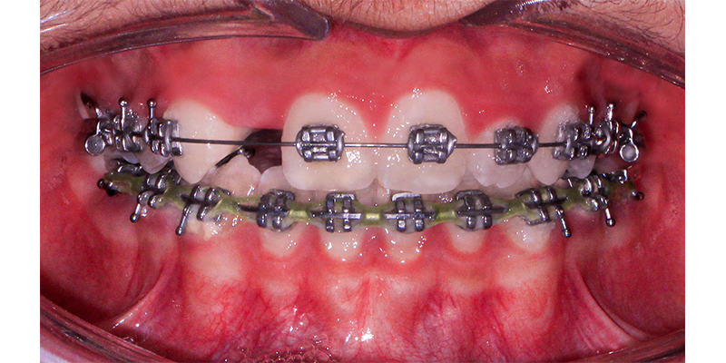 بستن فضای غایب دندان ها با ارتودنسی
