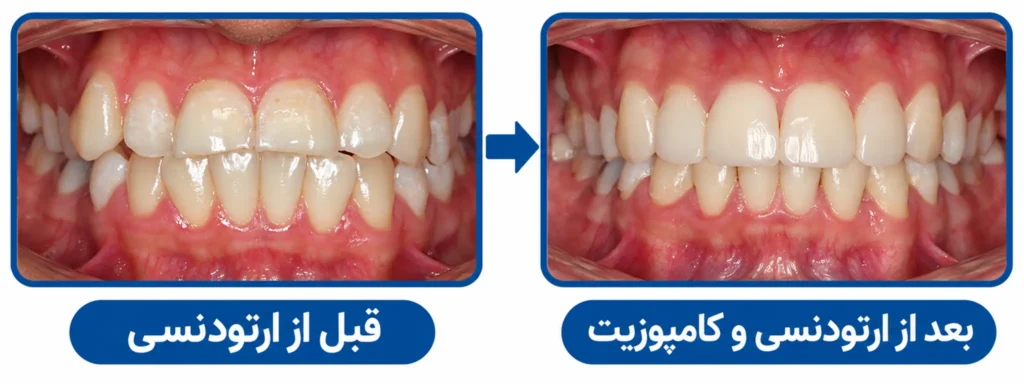 ارتودنسی بهتر است یا کامپوزیت؟
