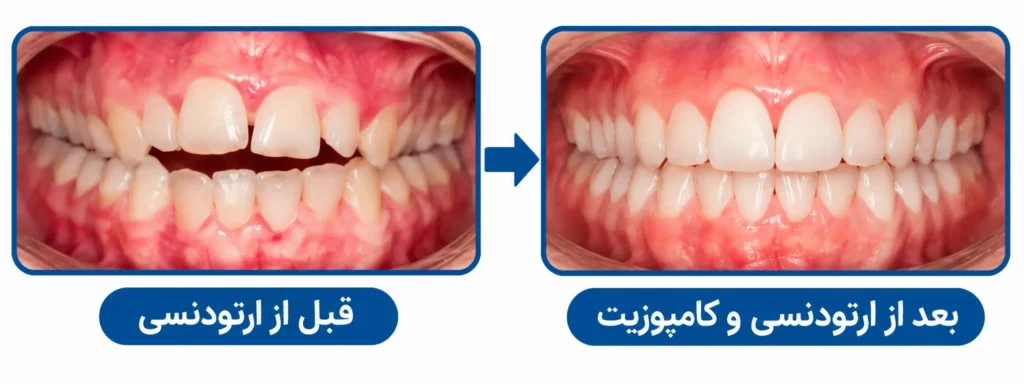 ارتودنسی بهتر است یا کامپوزیت؟