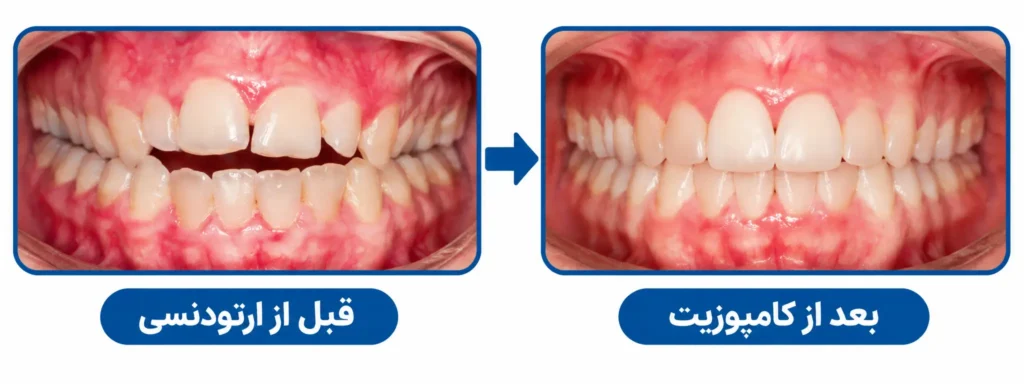 ارتودنسی بهتر است یا کامپوزیت؟