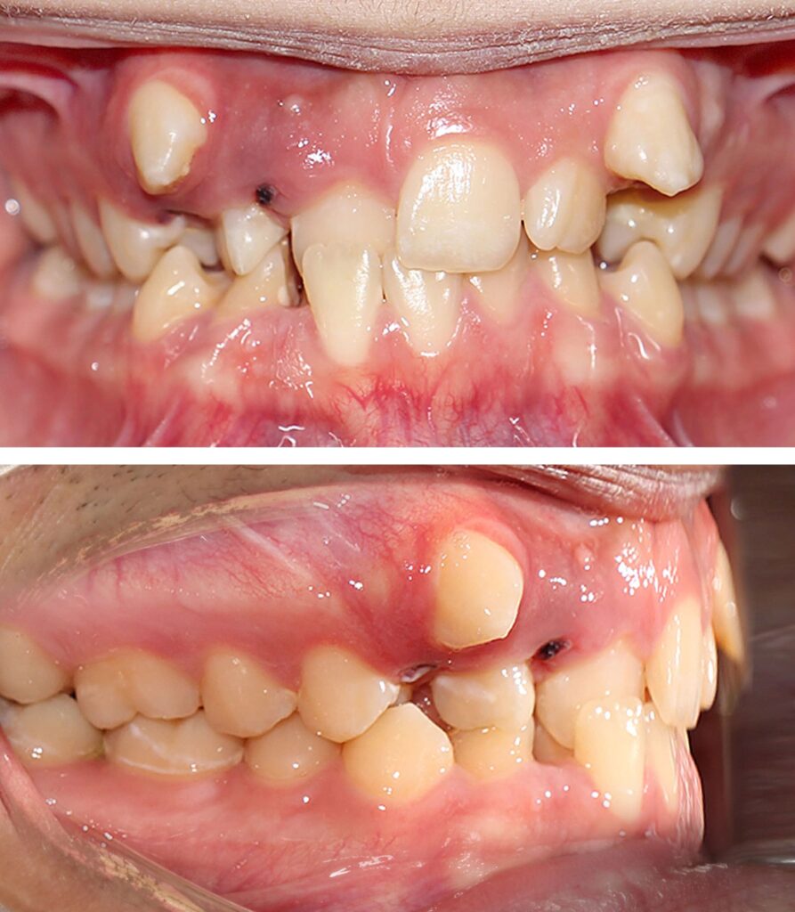قبل از ارتودنسی دندان نیش نهفته