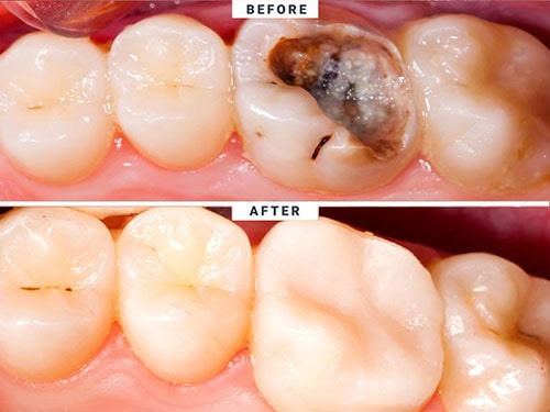 قبل و بعد پر کردن دندان دکتر کریم زاده