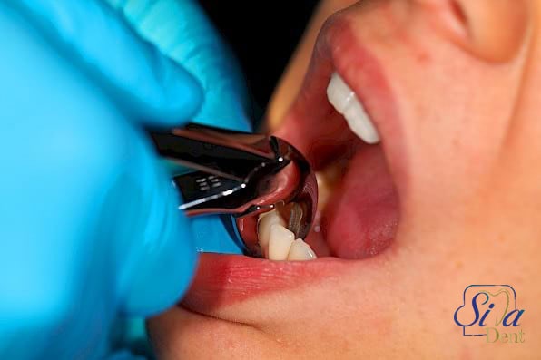 درمان آبسه دندان با کشیدن دندان