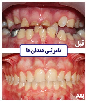 متخصص ارتودنسی برای درمان دندان‌های به هم ریخته