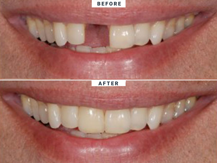 simadentclinic dental implant portfolio 1