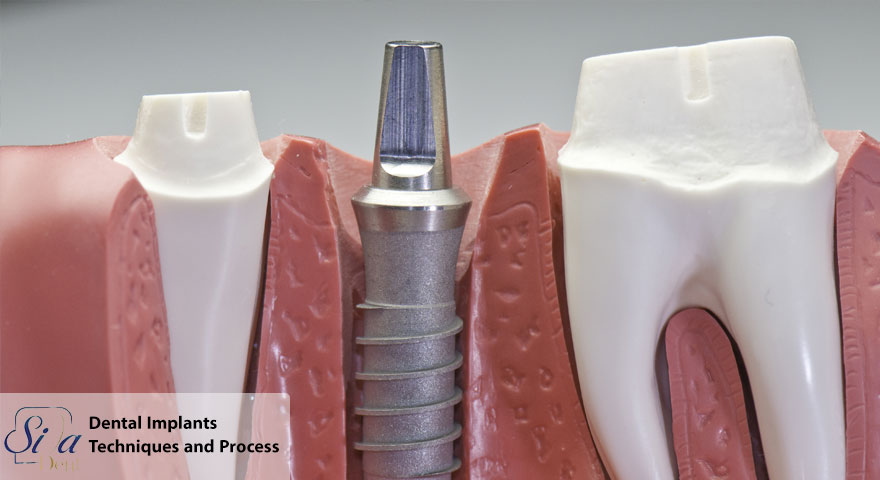Dental Implants Techniques and Process